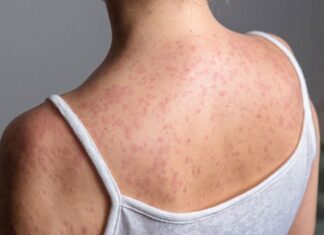 Sarampión en retroceso: 30% menos casos gracias a vacunas masivas