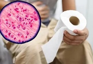 ¿Qué es la ciclosporiasis? La infección vinculada a un brote gastrointestinal en Estados Unidos